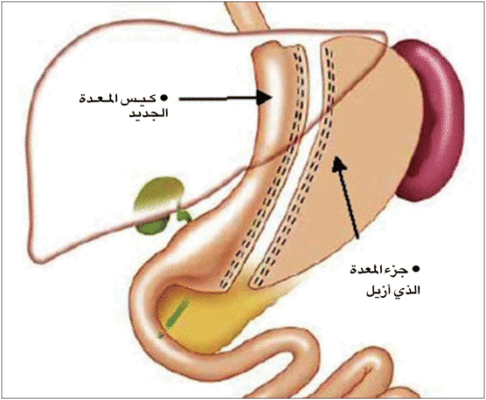 مخاطر و فوائد عملية تكميم المعدة لإنقاص الوزن