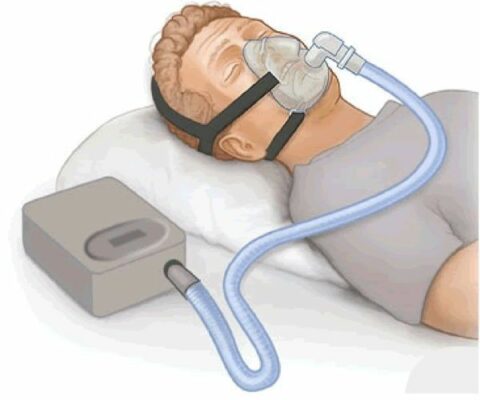 إنقطاع التنفس أثناء النوم و جهاز micro CPAP  بدون خراطيم و أسلاك لعلاج المشكلة